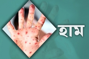 সিলেটে হামের উপসর্গ নিয়ে আরেক শিশুর মৃত্যু