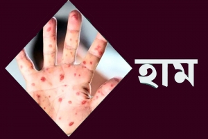 সিলেটে হাম রোগে আরও ২ শিশুর মৃত্যু